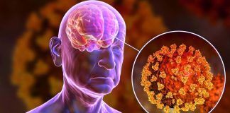 SARS-CoV-2 Infections Can Also Cause Long Term Peripheral Nerve Demyelination And Axonal Loss