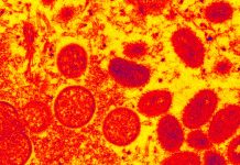 Monkeypox can lead to death with encephalitis or inflammation of the brain