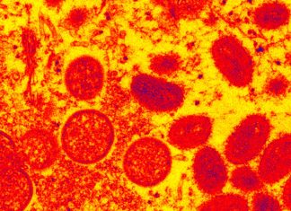 Monkeypox can lead to death with encephalitis or inflammation of the brain