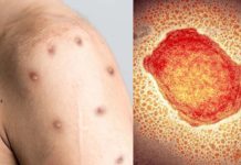 WHO Says Monkeypox Cases Expected To Rise Exponentially In Coming Weeks