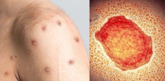 WHO Says Monkeypox Cases Expected To Rise Exponentially In Coming Weeks