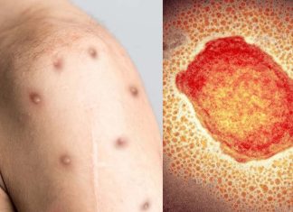 WHO Says Monkeypox Cases Expected To Rise Exponentially In Coming Weeks
