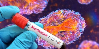 Rilevazione prolungata del DNA del virus del vaiolo delle scimmie nei tamponi nasofaringei, nelle urine e nei campioni di sangue