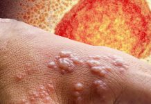 Scientists Finds Monkeypox Virus In Semen Of Infected Men Even Weeks After First Symptom Appears