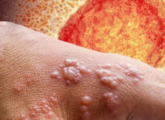 Scientists Finds Monkeypox Virus In Semen Of Infected Men Even Weeks After First Symptom Appears