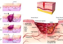 Degradable polythioketal (PTK) urethane (UR) foams with varied hydrophilicity for skin wound healing