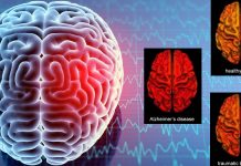 Researchers identified a unique biomarker associated with only the chronic or acute stage of traumatic brain injury