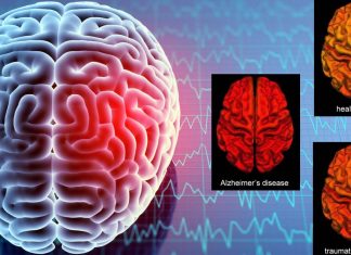 Researchers identified a unique biomarker associated with only the chronic or acute stage of traumatic brain injury
