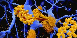 Alzheimer’s disease: the effects of somatostatin on Aβ agglomeration path depending on the presence or absence of metals