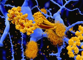 Alzheimer’s disease: the effects of somatostatin on Aβ agglomeration path depending on the presence or absence of metals