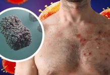 Scoperte infezioni asintomatiche da Monkeypox tra gli uomini che visitano la più grande clinica per infezioni a trasmissione sessuale (STI) in Belgio