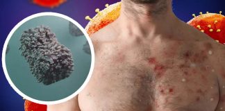 Scoperte infezioni asintomatiche da Monkeypox tra gli uomini che visitano la più grande clinica per infezioni a trasmissione sessuale (STI) in Belgio