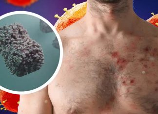 Scoperte infezioni asintomatiche da Monkeypox tra gli uomini che visitano la più grande clinica per infezioni a trasmissione sessuale (STI) in Belgio