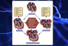 Structural or functional abnormalities within the heart’s left atrium may increase a person’s risk of developing dementia later in life by 35%