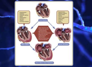Structural or functional abnormalities within the heart’s left atrium may increase a person’s risk of developing dementia later in life by 35%