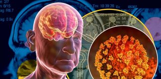 Il COVID-19 può predisporre le persone a condizioni neurologiche irreversibili