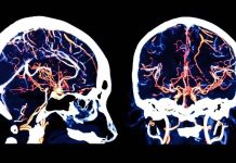 NeuroCOVID Study Shows That SARS-CoV-2 Infections Causes Serious Damage To Microvessels In the Brain