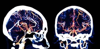 NeuroCOVID Study Shows That SARS-CoV-2 Infections Causes Serious Damage To Microvessels In the Brain
