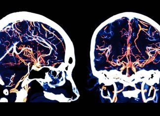 NeuroCOVID Study Shows That SARS-CoV-2 Infections Causes Serious Damage To Microvessels In the Brain