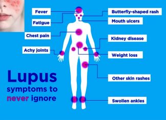 LUPUS: Afimetoran a newly developed pill to treat lupus not only prevents lupus-like symptoms but also reverses signs of organ damage