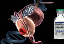 Betamethasone could be used to reduce unwanted side effects of radiation treatments for prostate cancer