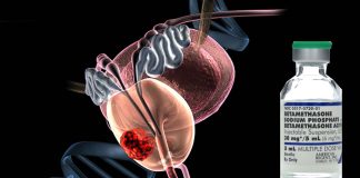 Betamethasone could be used to reduce unwanted side effects of radiation treatments for prostate cancer