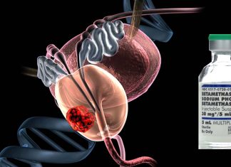 Betamethasone could be used to reduce unwanted side effects of radiation treatments for prostate cancer