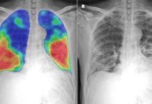 40 Percent Of Post-COVID Pneumonia Patients Still Have Impaired Lung Diffusion