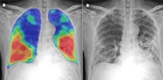 40 Percent Of Post-COVID Pneumonia Patients Still Have Impaired Lung Diffusion