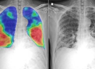 40 Percent Of Post-COVID Pneumonia Patients Still Have Impaired Lung Diffusion
