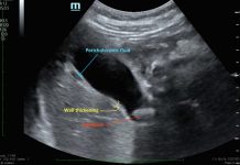 US FDA Study Discovers That Diabetics Taking GLP-1 Receptor Agonists Drugs Have Higher Risk Of Acute Cholecystitis