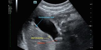 US FDA Study Discovers That Diabetics Taking GLP-1 Receptor Agonists Drugs Have Higher Risk Of Acute Cholecystitis