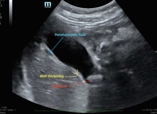 US FDA Study Discovers That Diabetics Taking GLP-1 Receptor Agonists Drugs Have Higher Risk Of Acute Cholecystitis