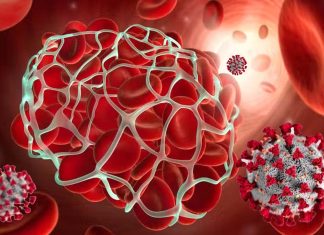 Blood Clots Caused By SARS-CoV-2 Infections Poses A Threat For Fatal Vascular Events For Up To 49 Weeks After Diagnosis