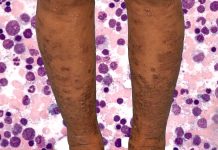 Asymptomatic SARS-CoV-2 Infections Can Trigger Acute Exacerbation of Idiopathic Hypereosinophilic Syndrome