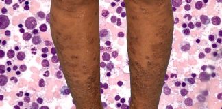 Asymptomatic SARS-CoV-2 Infections Can Trigger Acute Exacerbation of Idiopathic Hypereosinophilic Syndrome