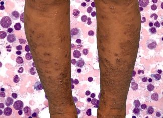 Asymptomatic SARS-CoV-2 Infections Can Trigger Acute Exacerbation of Idiopathic Hypereosinophilic Syndrome