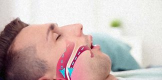 Sufferers of obstructive sleep apnea are at increased risk of developing cancer and thrombosis