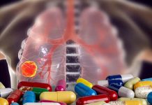 New long-term use of opioids to quell pain after lung cancer surgery is linked to a 40% heightened risk of death from any cause within the next 2 years