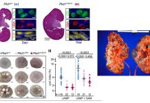 Researchers have found a promising target for the treatment of polycystic kidney disease (PKD)