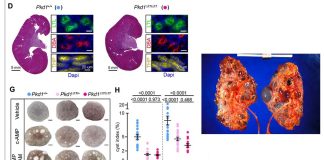 Researchers have found a promising target for the treatment of polycystic kidney disease (PKD)