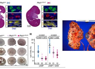 Researchers have found a promising target for the treatment of polycystic kidney disease (PKD)