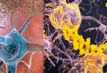 A new study finds that Alzheimer’s disease is caused by low levels of beta amyloid protein and not by amyloid plaques