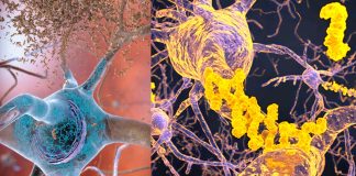 A new study finds that Alzheimer’s disease is caused by low levels of beta amyloid protein and not by amyloid plaques