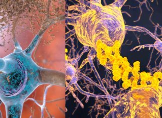 A new study finds that Alzheimer’s disease is caused by low levels of beta amyloid protein and not by amyloid plaques