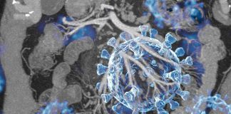 COVID-19 can cause acute abdominal pains in individuals as a result of Mesenteric Panniculitis