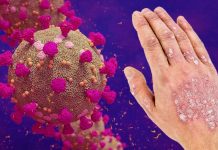 Le infezioni da SARS-Cov-2 possono causare una varietà di malattie infiammatorie immuno-mediate tra cui T1DM – IBD – Psoriasi