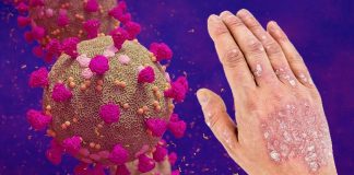 Le infezioni da SARS-Cov-2 possono causare una varietà di malattie infiammatorie immuno-mediate tra cui T1DM – IBD – Psoriasi