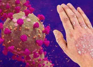 Le infezioni da SARS-Cov-2 possono causare una varietà di malattie infiammatorie immuno-mediate tra cui T1DM – IBD – Psoriasi