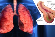 A key step toward improving and lengthening the lives of cystic fibrosis patients